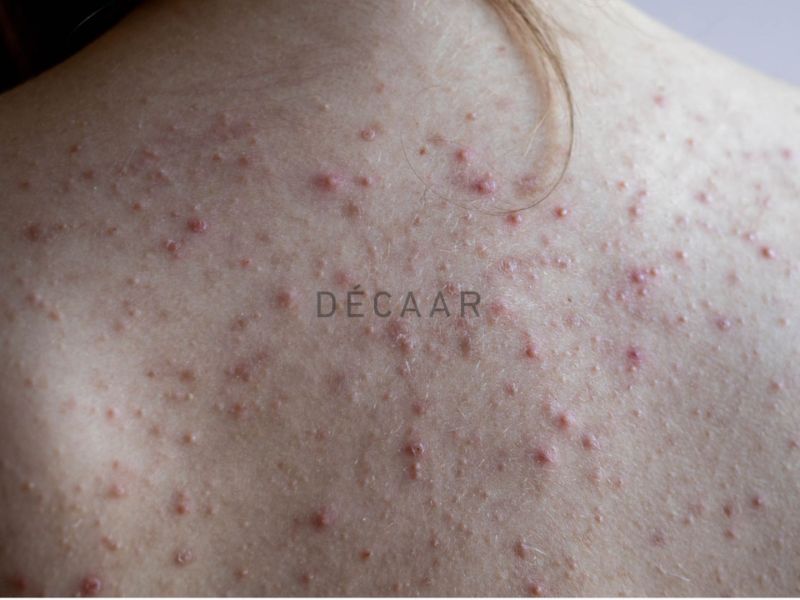 Tuyến bã nhờn hoạt động mạnh